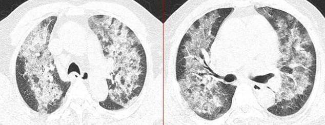 “白肺恐慌”四起！中国多地医院“排长龙扫描肺部” 需求量暴增6倍、登微博热搜焦点
